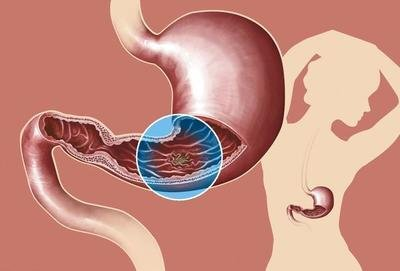 做好這些|慢性萎縮性胃炎離胃癌就會更遠(yuǎn)！